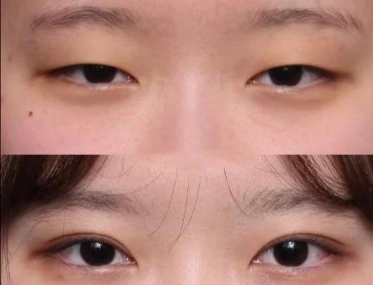 当双眼皮贴无法拯救无神的单眼皮时 你想不想割双眼皮 知乎 当双眼皮贴无法拯救无神的单眼皮时 你想不想割双眼皮 知乎