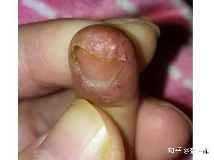 甲周疣3岁时患甲周疣多次治疗复发4岁终找对方法