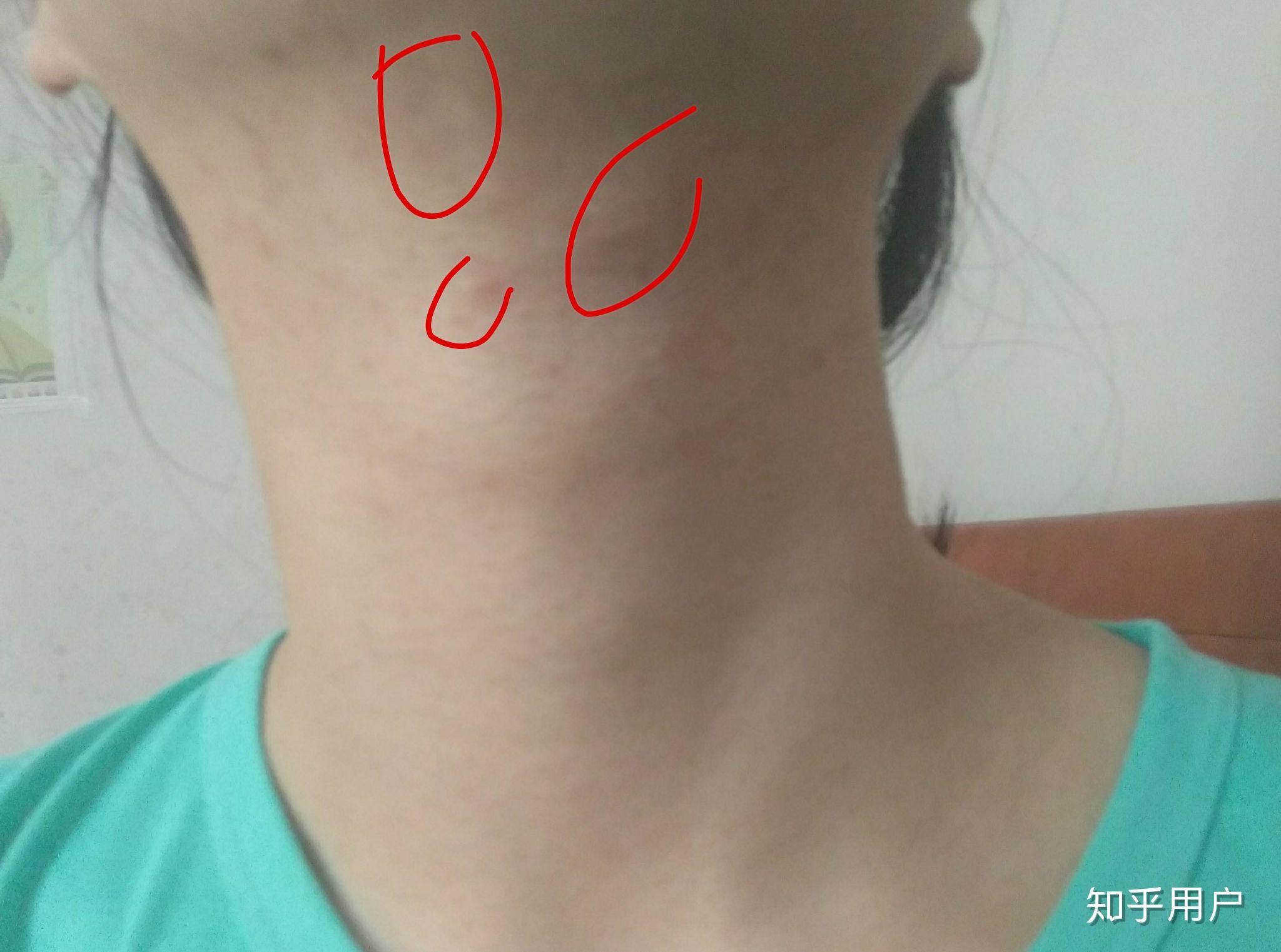 脖子淋巴结有些大已经10多年了不痛不痒偶尔感冒生病会有些胀近期发现