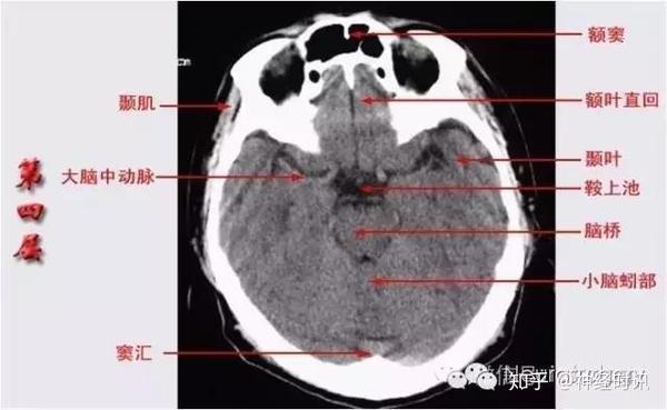 解剖&影像 —— 颅脑CT解剖口诀及彩色解剖图 - 知乎