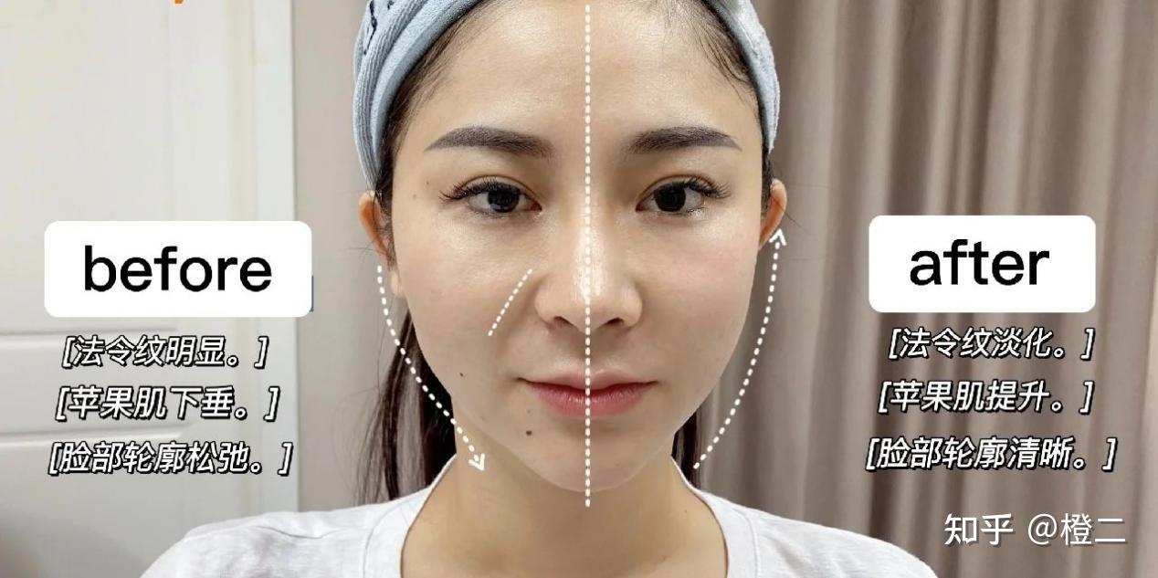 引起眉尾/眼角下垂,鼻唇沟松弛加深,口角区域松弛下垂,下颌轮廓模糊等