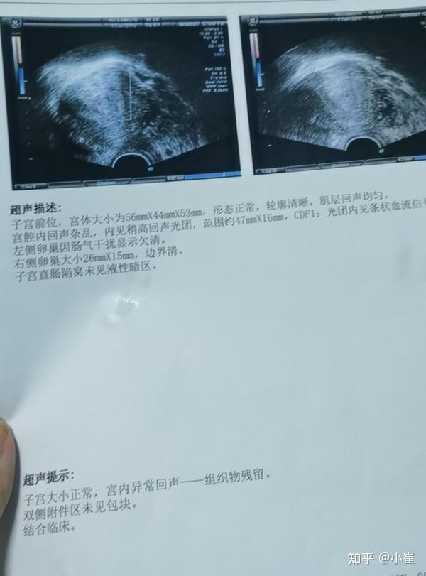 孕9周流产需要清宫吗 9周胎停人流还是清宫 药流加清宫是2次伤害吗