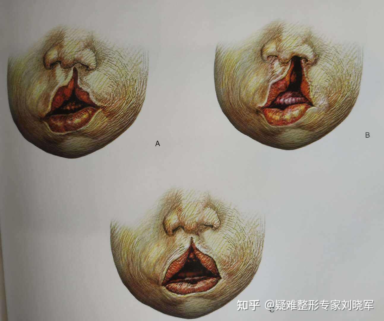 唇裂和腭裂是最常见的先天性畸形之一,唇裂或唇裂合并腭裂的发生率