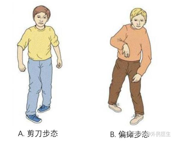 痉挛型脑瘫的表现 - 知乎