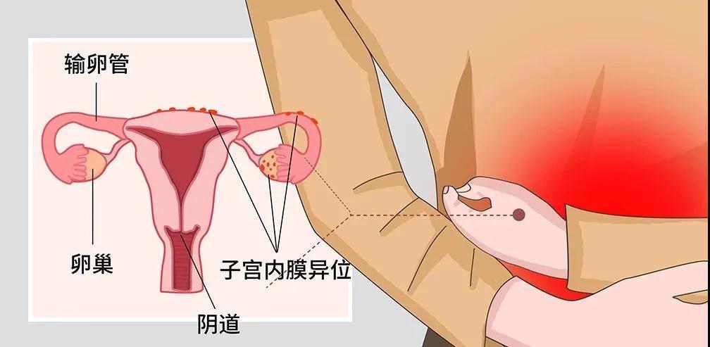 研究人員確定子宮內膜異位症的遺傳原因並揭示潛在的藥物靶點