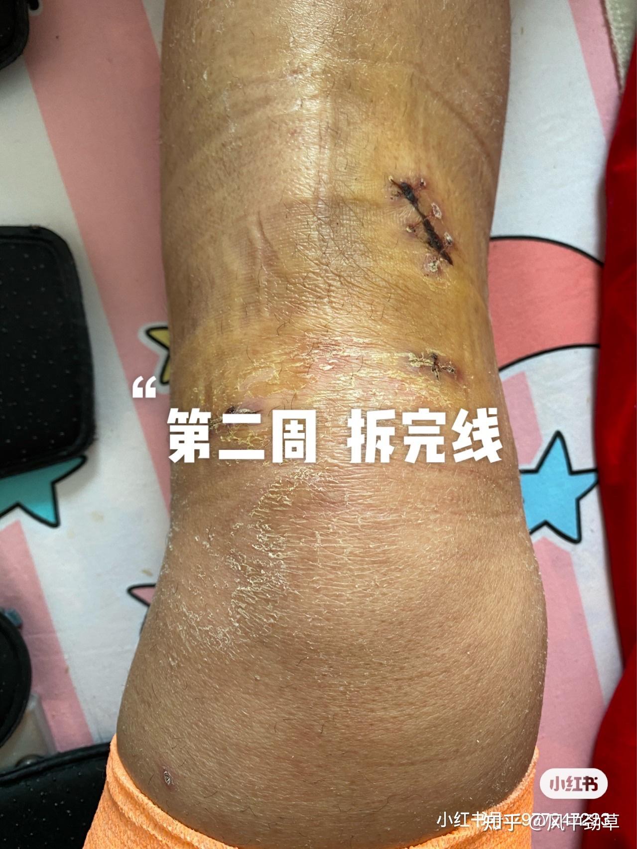 前交叉韧带重建术 半月板缝合一针