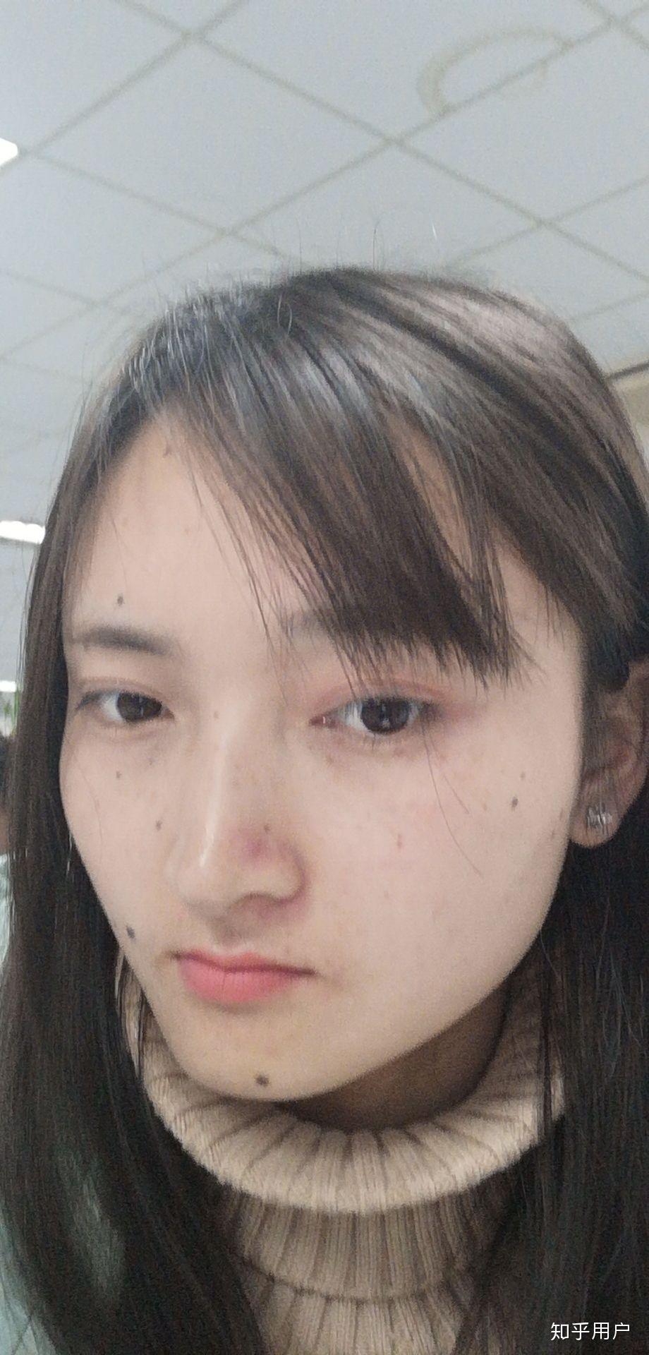 脸上长很多痣是一种怎样的体验?