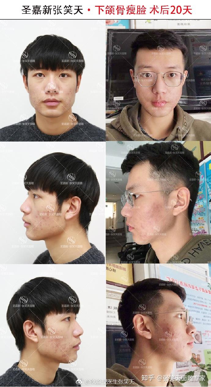 成都哪家医院做下颌角整形手术比较好？