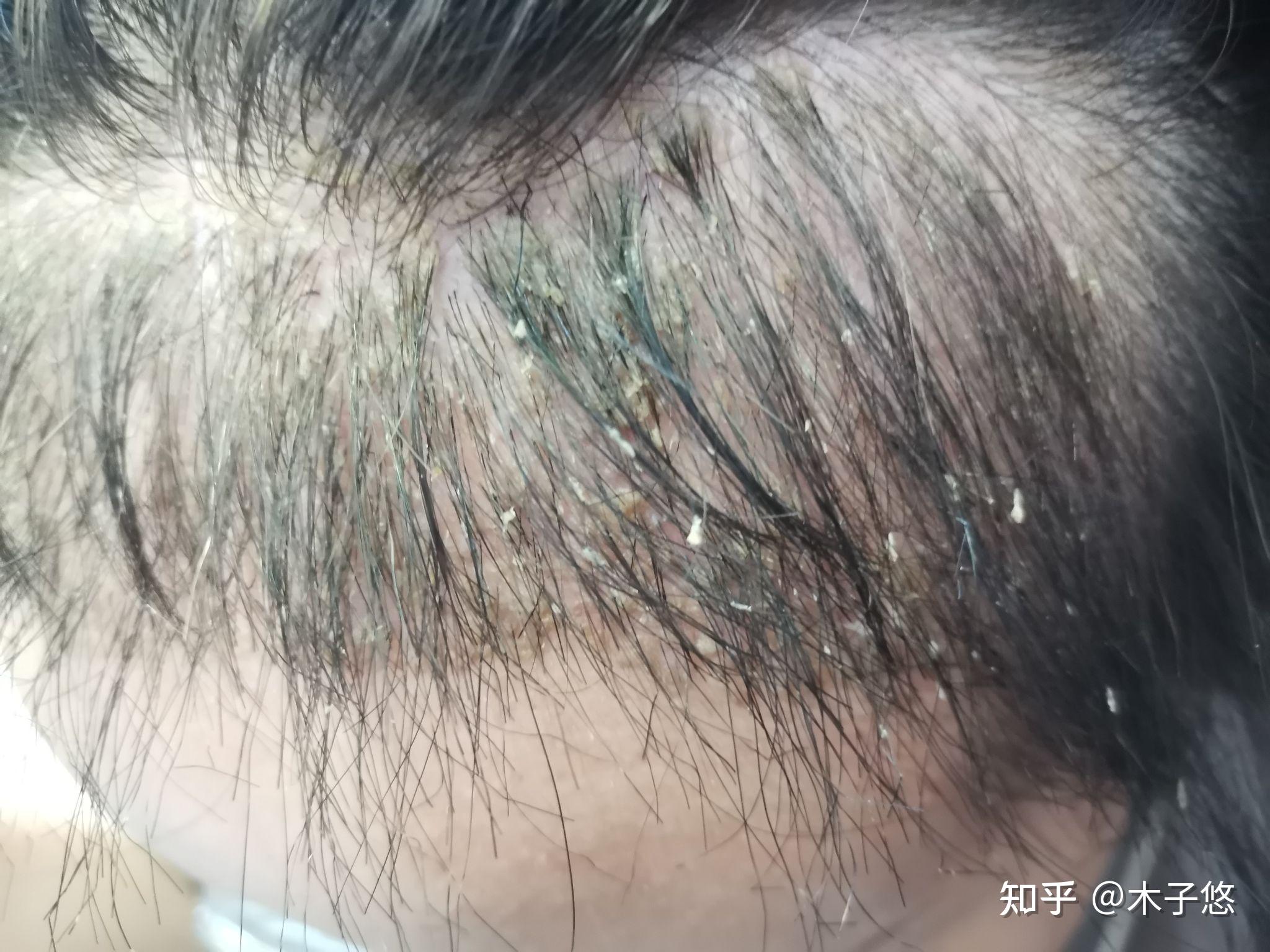 植发区感觉蠕动(植发后感觉头皮在动)
