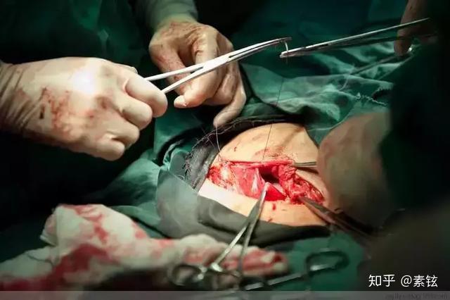手术过程中虽然也出了不少血,但没有流个不停现在采用的是内缝合技术