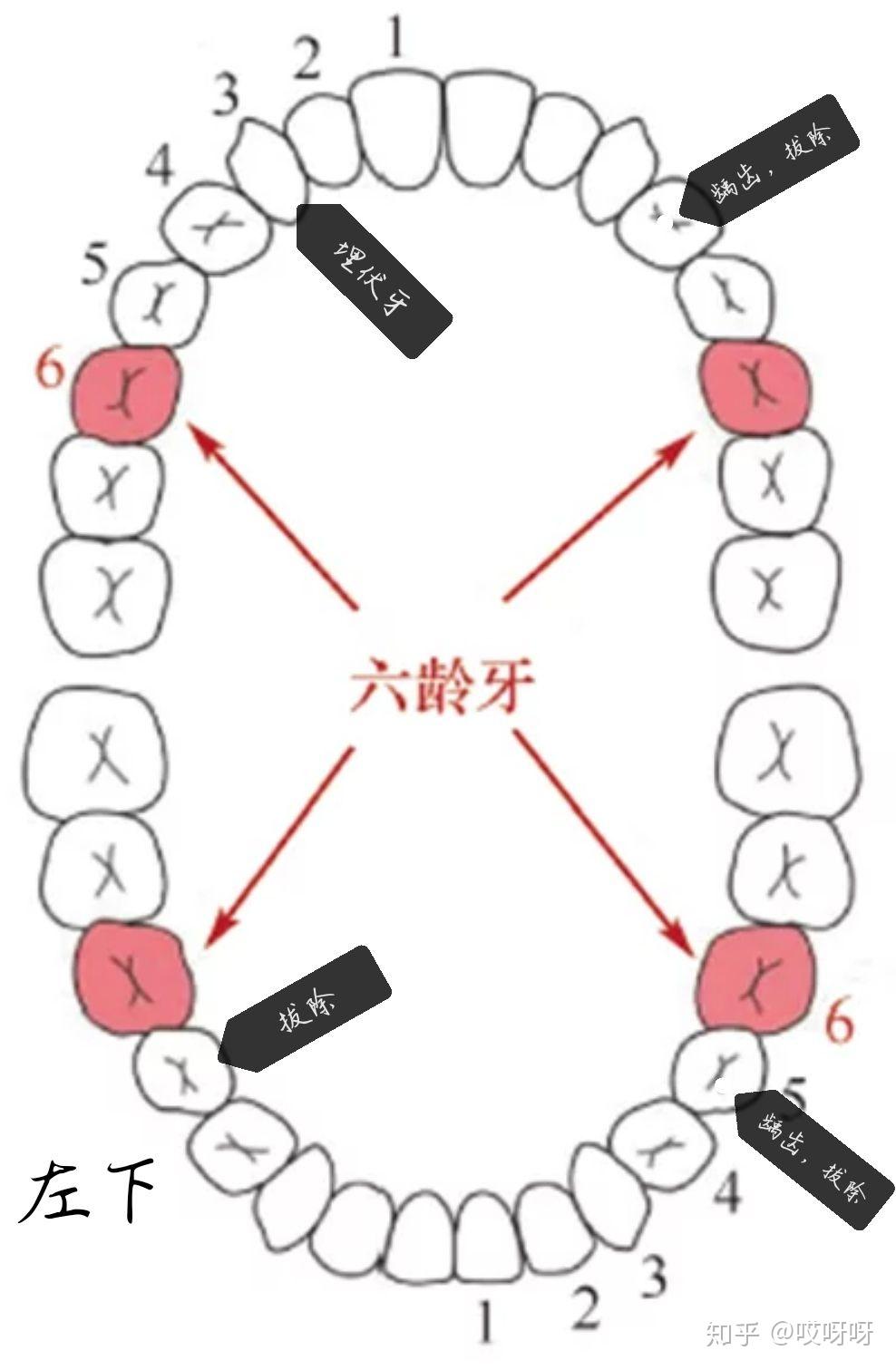 正畸分享虎牙埋伏牙