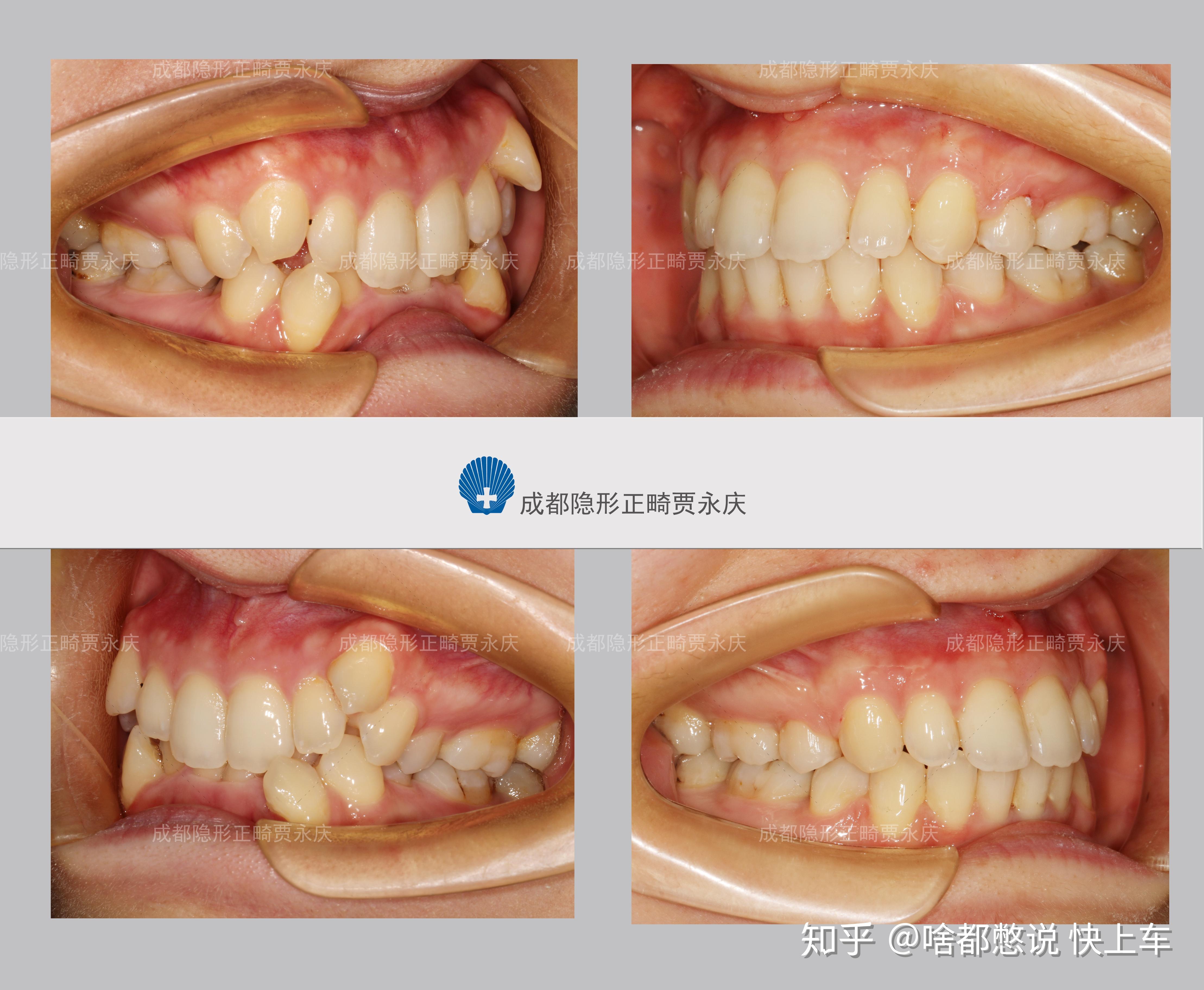 牙齿深覆合的图片对比图片