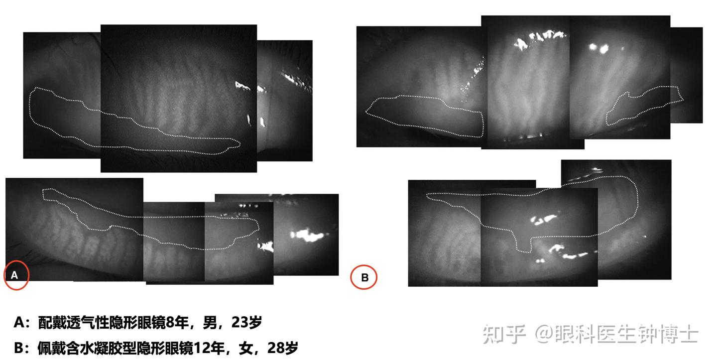 如果你有佩戴隐形眼镜的习惯，一定要看！ - 知乎