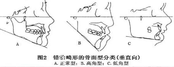 牙齒矯正兩年了牙縫還沒關上正常嗎