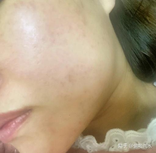 粉刺怎么消除才能彻底 v2-0976712a519f6b27ad23d57fdc64e156_r.jpg