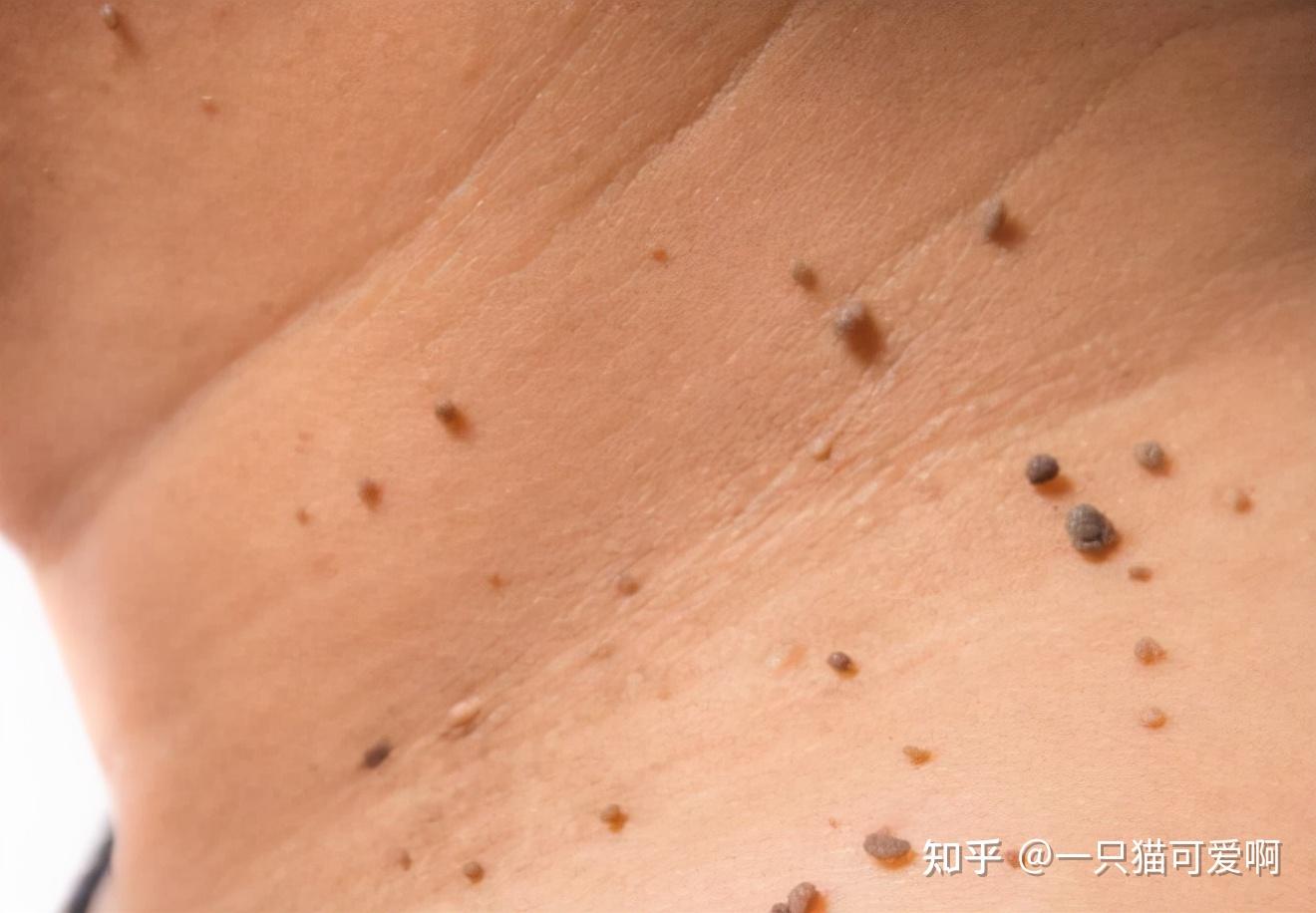 提醒女性小心身边这2种人是有八九十感染hpv一眼就能看出来