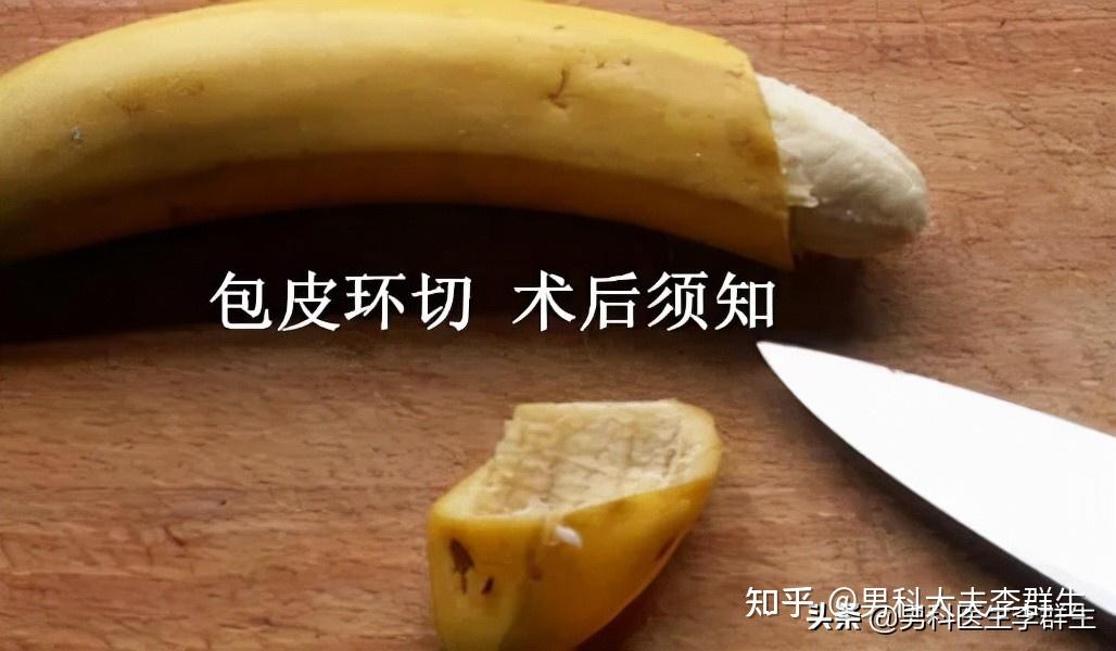 一次性缝合器包皮环切术后注意事项