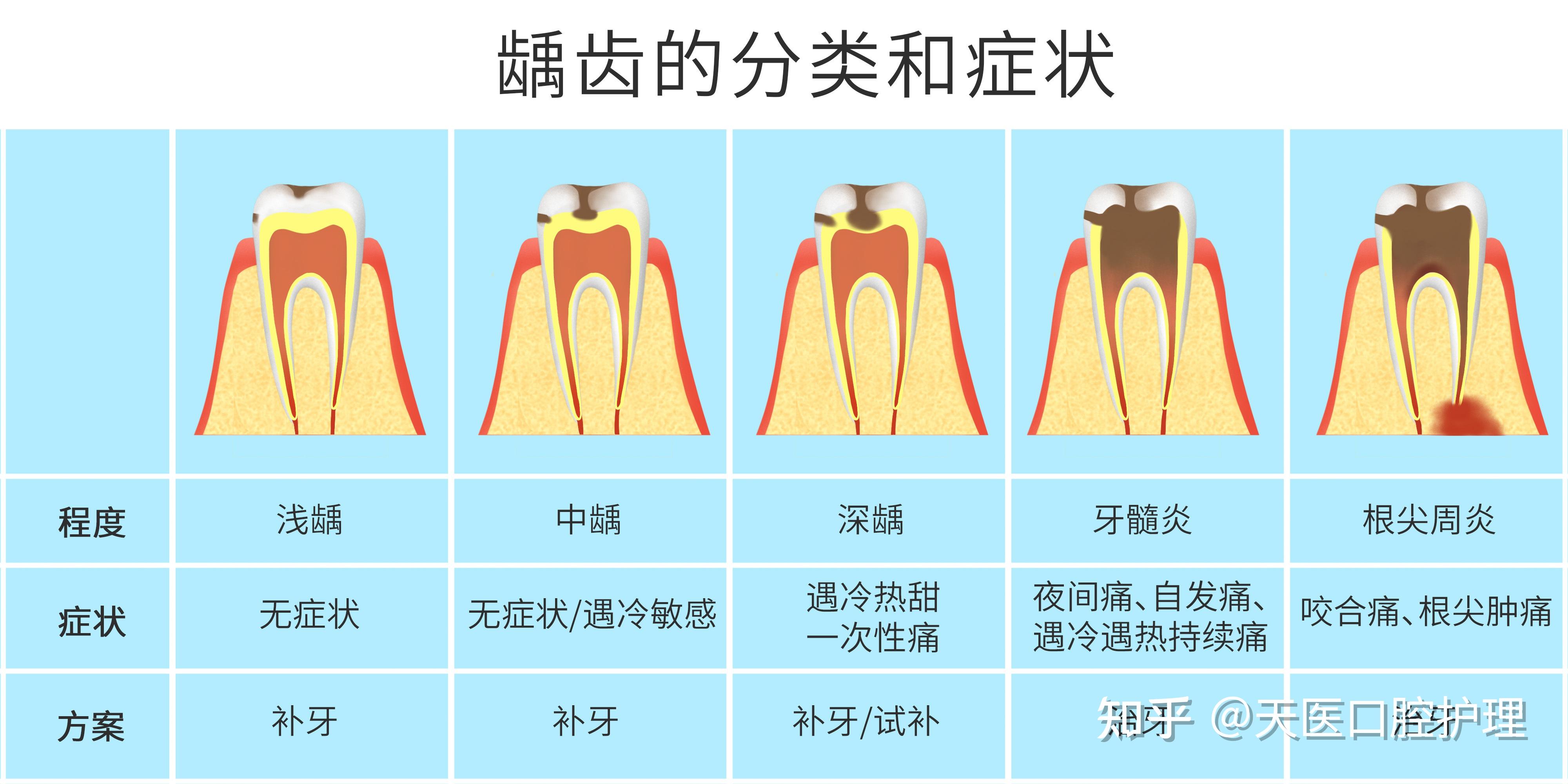 南京德牙联合口腔陈杰：龋齿的成因及预防方法 - 哔哩哔哩