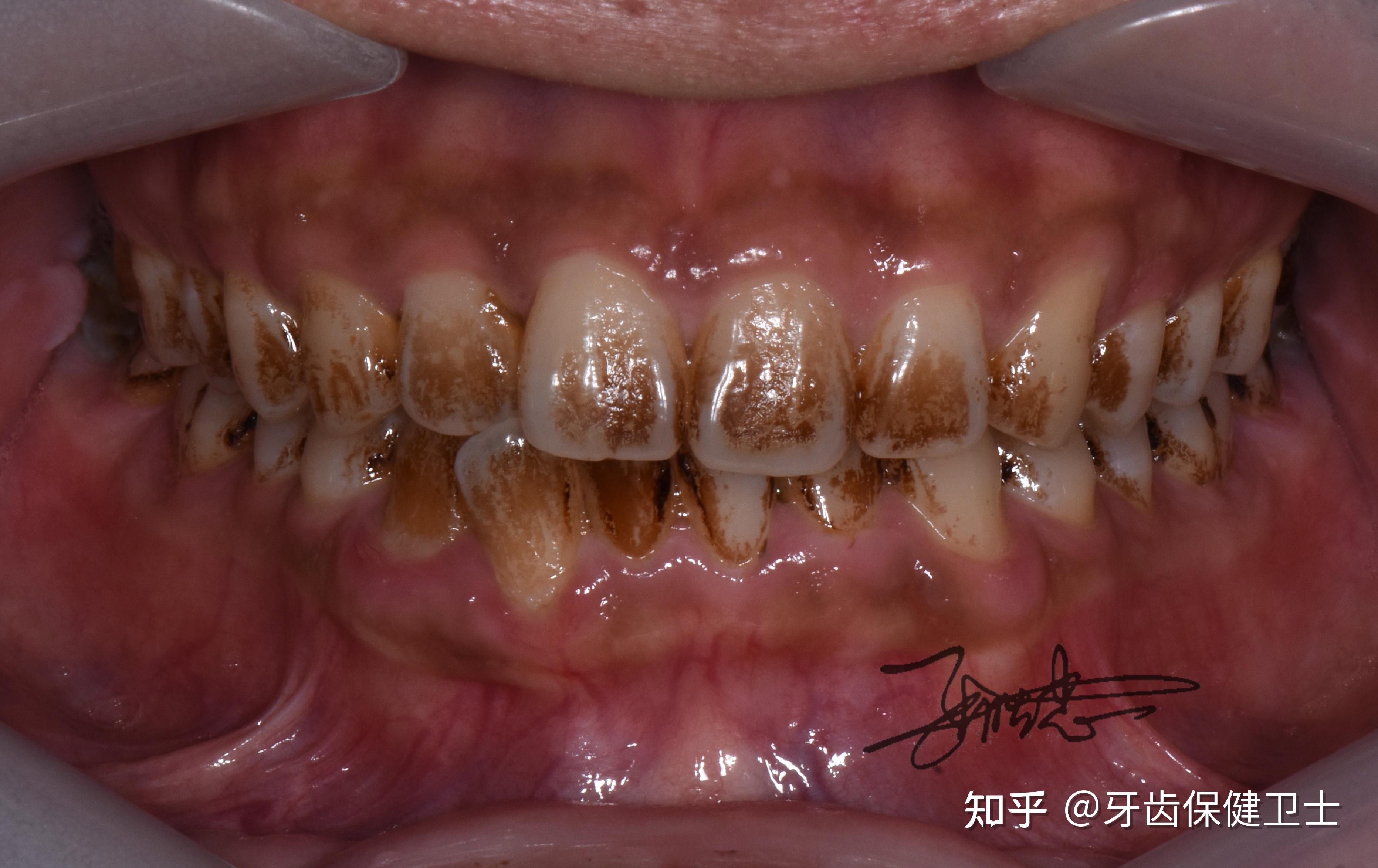 牙齿美白您知多少呢