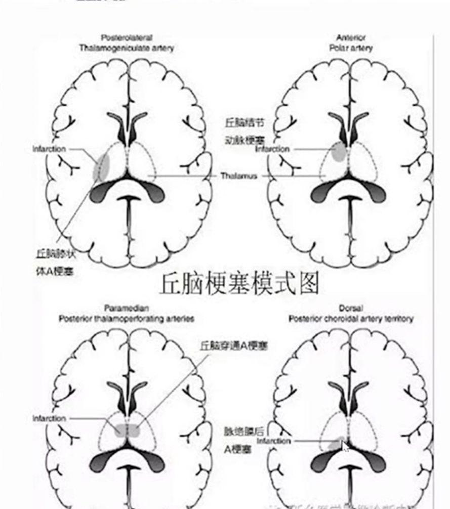 神内临床笔记42 基底节&丘脑病变