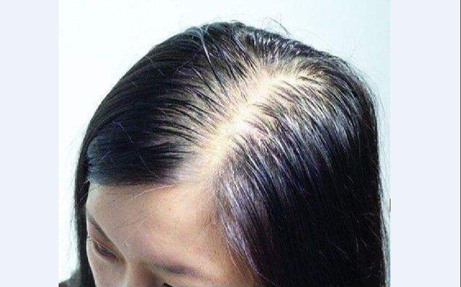发缝稀疏该怎么拯救? - 知乎