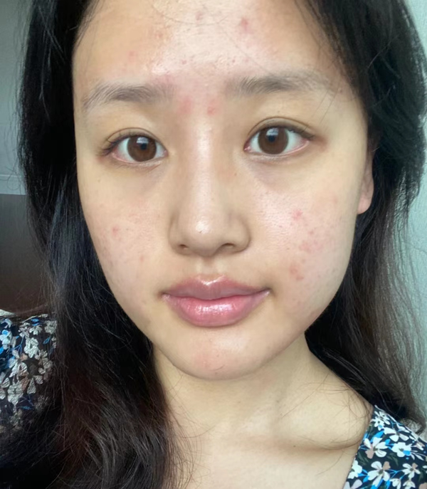痘印一直下不去，新痘印摞老痘印越来越严重，有什么办法能彻底解决痘印啊？？ - 知乎