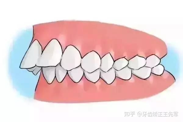 牙齿矫正拔牙是什么原因?苏州口腔医院哪
