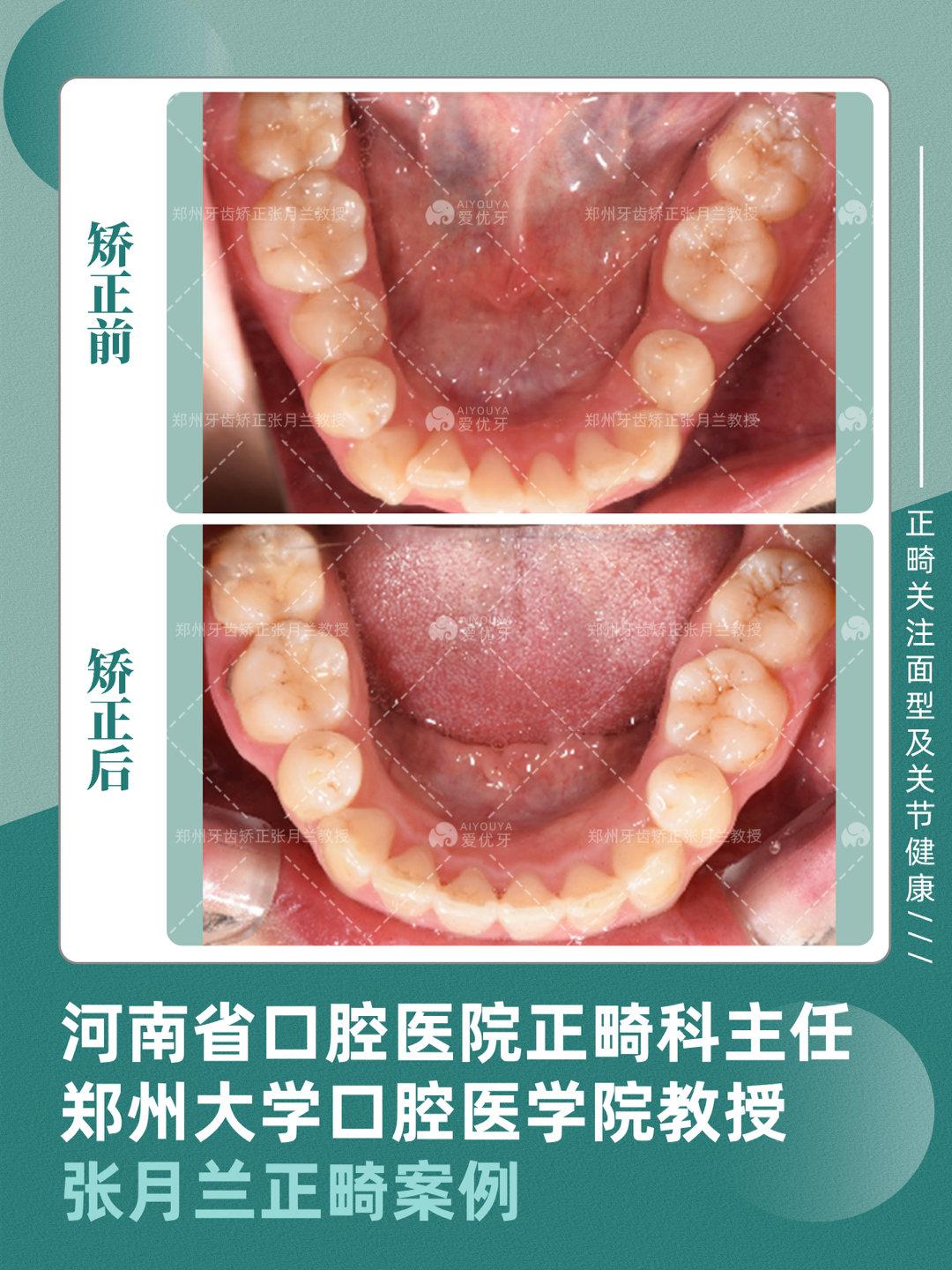 郑州牙齿矫正下颌后缩深覆盖牙弓狭窄案例