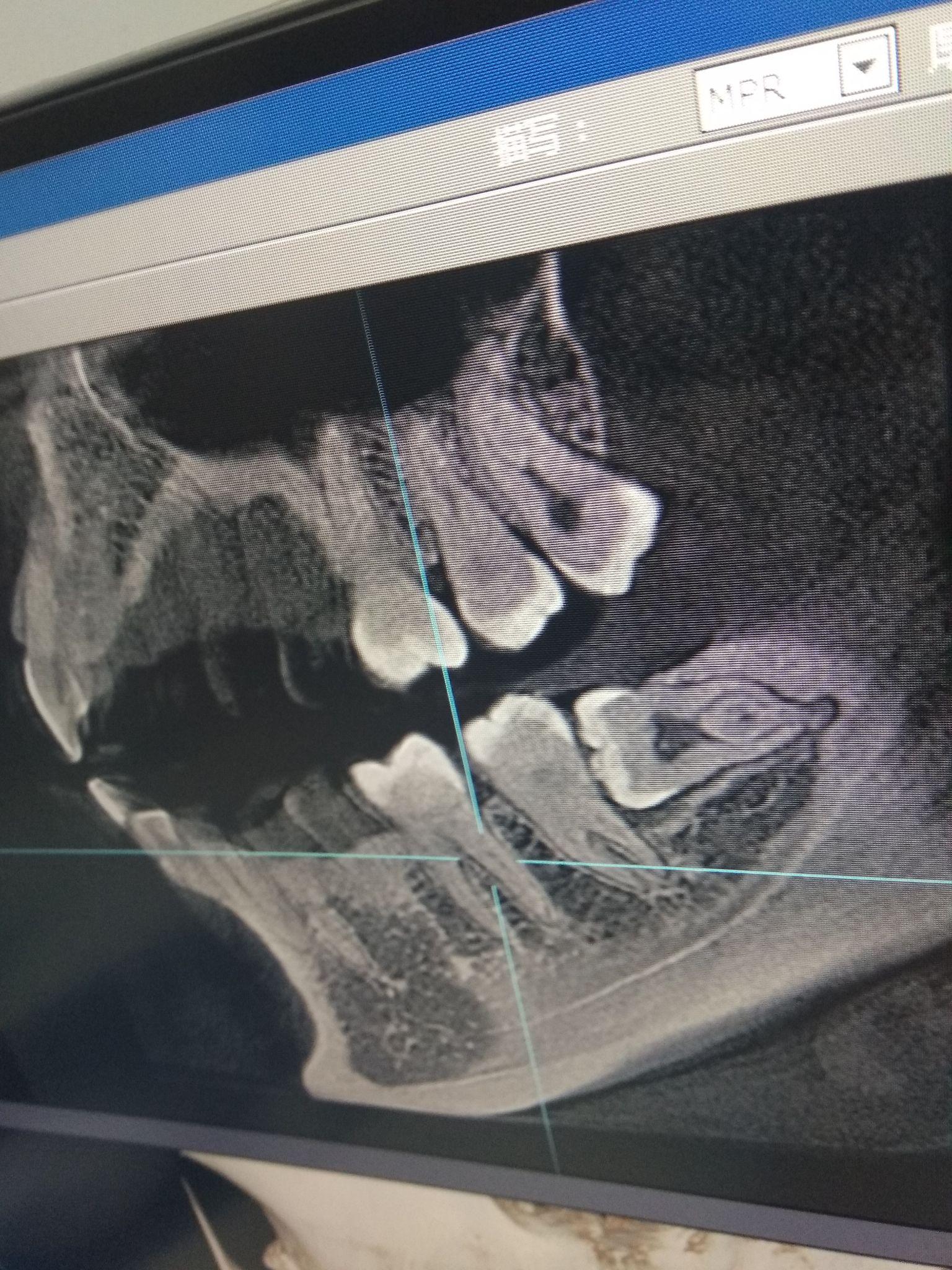 拔完智齿后,不仅牙龈肿痛,连脖子都肿了,咽口水