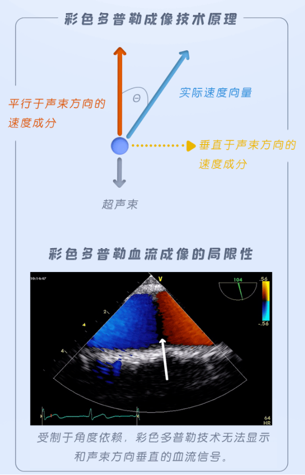 bsi血流斑点追踪成像技术