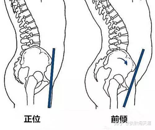 长短脚 可能是骨盆惹的祸 知乎