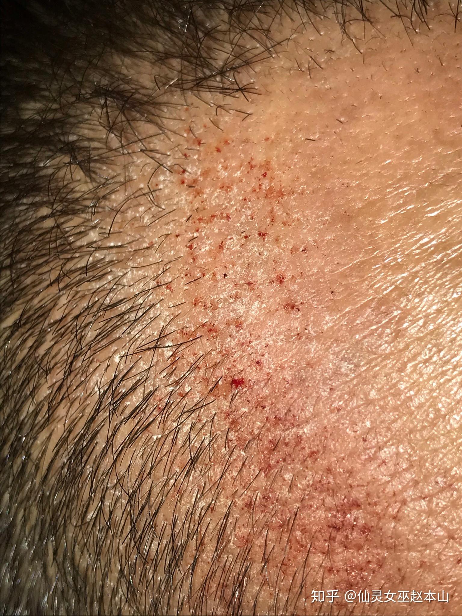 微针滚轮77米诺地尔失败改服用非那更新到头发长出来为止