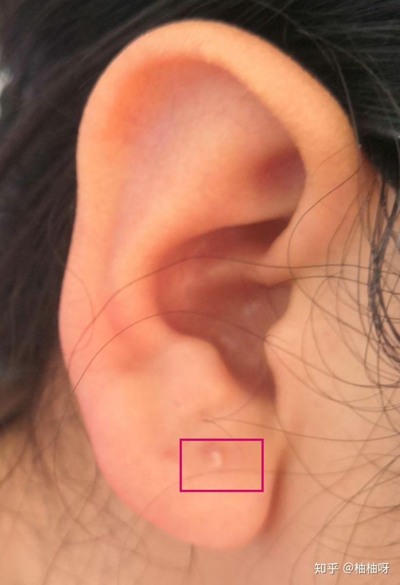关于我耳洞瘢痕疙瘩的治疗记录 