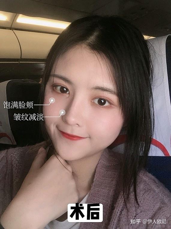 填充面部用什么最好_填充面部_脂肪填充面部