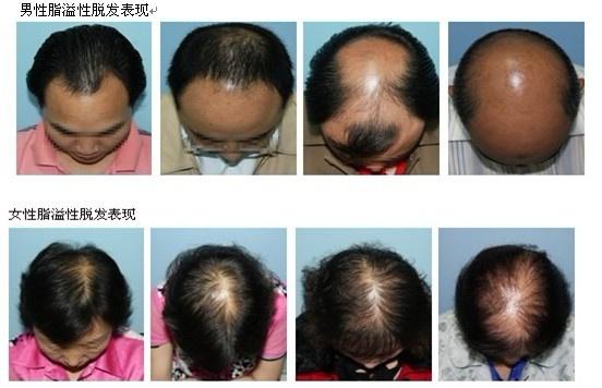 又称为早秃,男性型脱发,雄性脱发,弥漫性脱发,普通性脱发,遗传脱发等