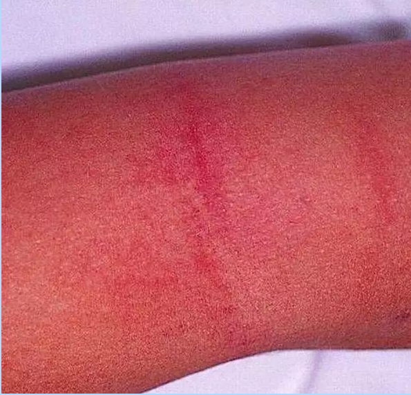 儿子得了一次猩红热我才知道这病最可怕的是这个