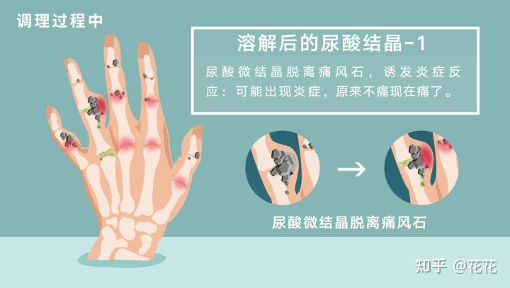 痛风高尿酸溶解尿酸盐结晶有什么反应会痛吗