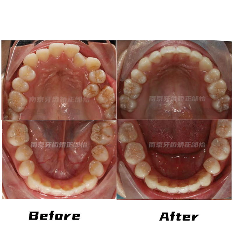 南京牙齒矯正南京整牙齙牙一定需要拔牙嗎年齡大矯正會不會有負影響