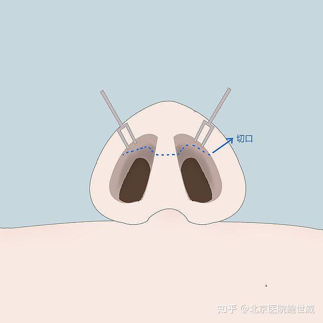 它的切口一般都位于鼻孔缘,鼻小柱这个位置,所以增生的几率不大,当然