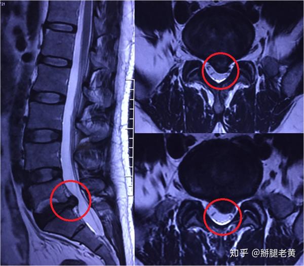 文献抄读腰椎间盘突出症的康复治疗中国专家共识