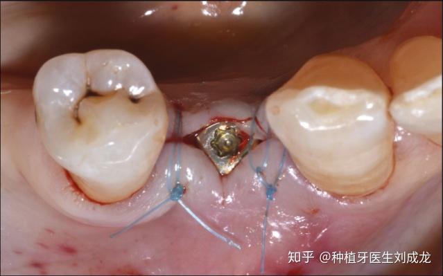 修复操作软硬组织经过两个月愈合后,种植体基台周围的软组织状况良好