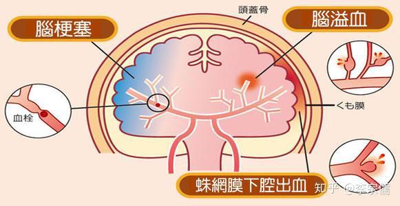 《重疾險》腦中風後遺症