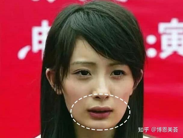 如果颧骨下方凹陷进去,正面看会显得口周单薄干瘪,嘴凸,刻薄又老气.