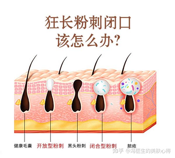 夏天必备的宝藏项目,粉刺、闭口统统消失掉! - 知乎