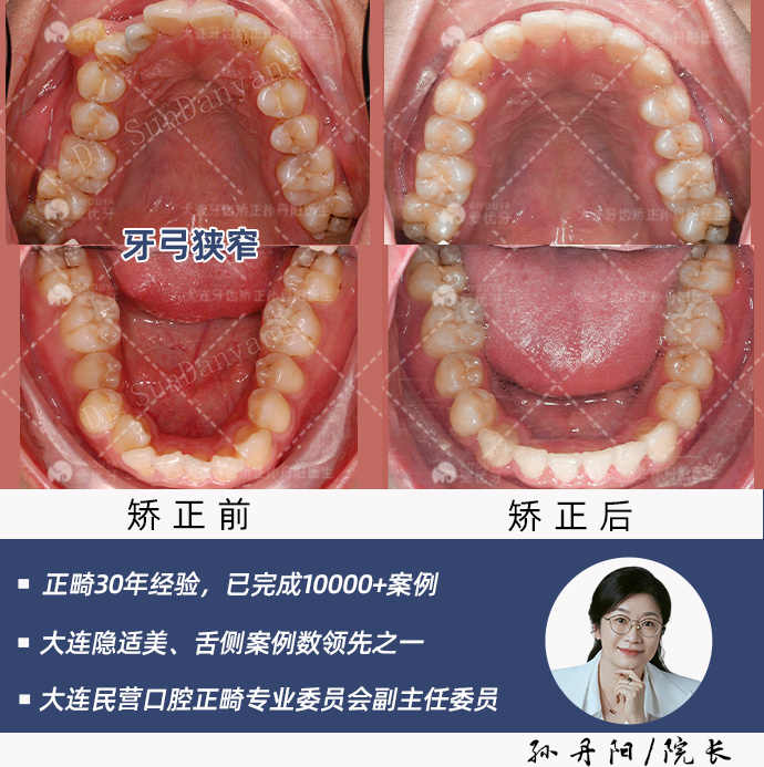 檢查發現他有一顆在右側上頜門牙和側切牙之間的多生牙,根據cbct牙根