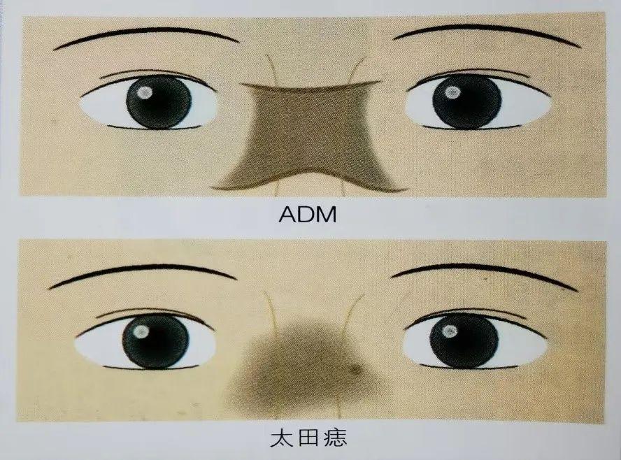 斑斑点点，傻傻分不清楚？褐青色痣和黄褐斑如何区分 | 北京崇文门分院李艳医生 - 知乎