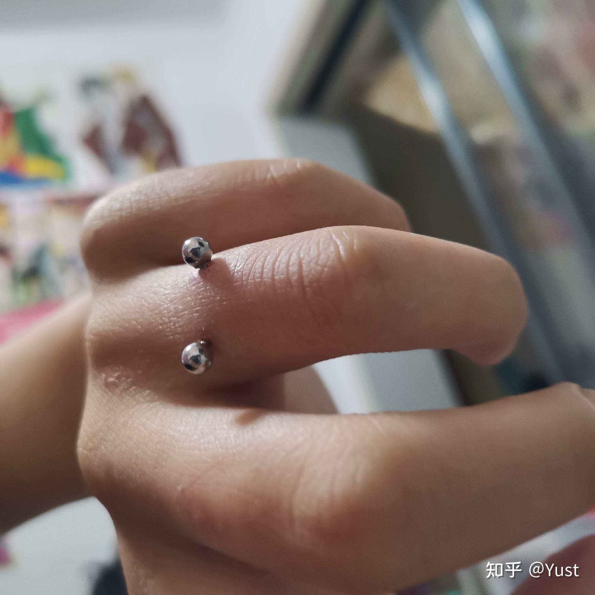 手指钉orward helix恢复记录 - 知乎