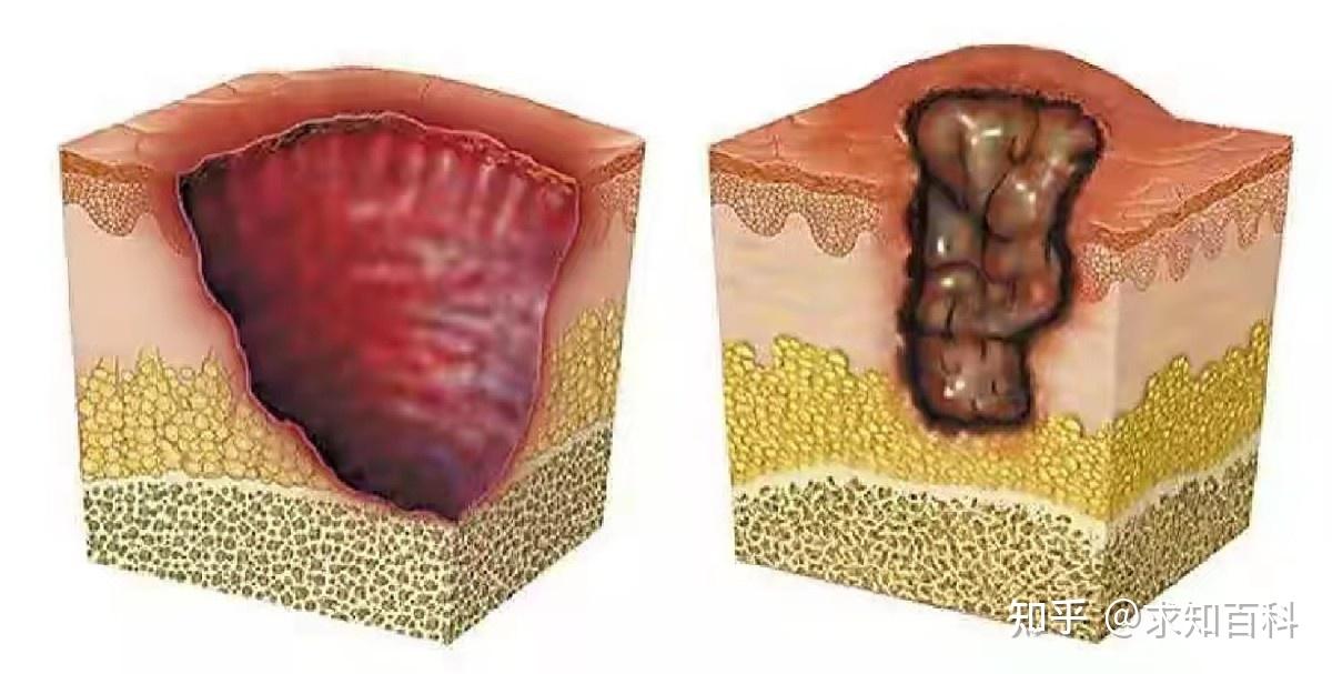 感染"食肉菌"究竟有多严重?