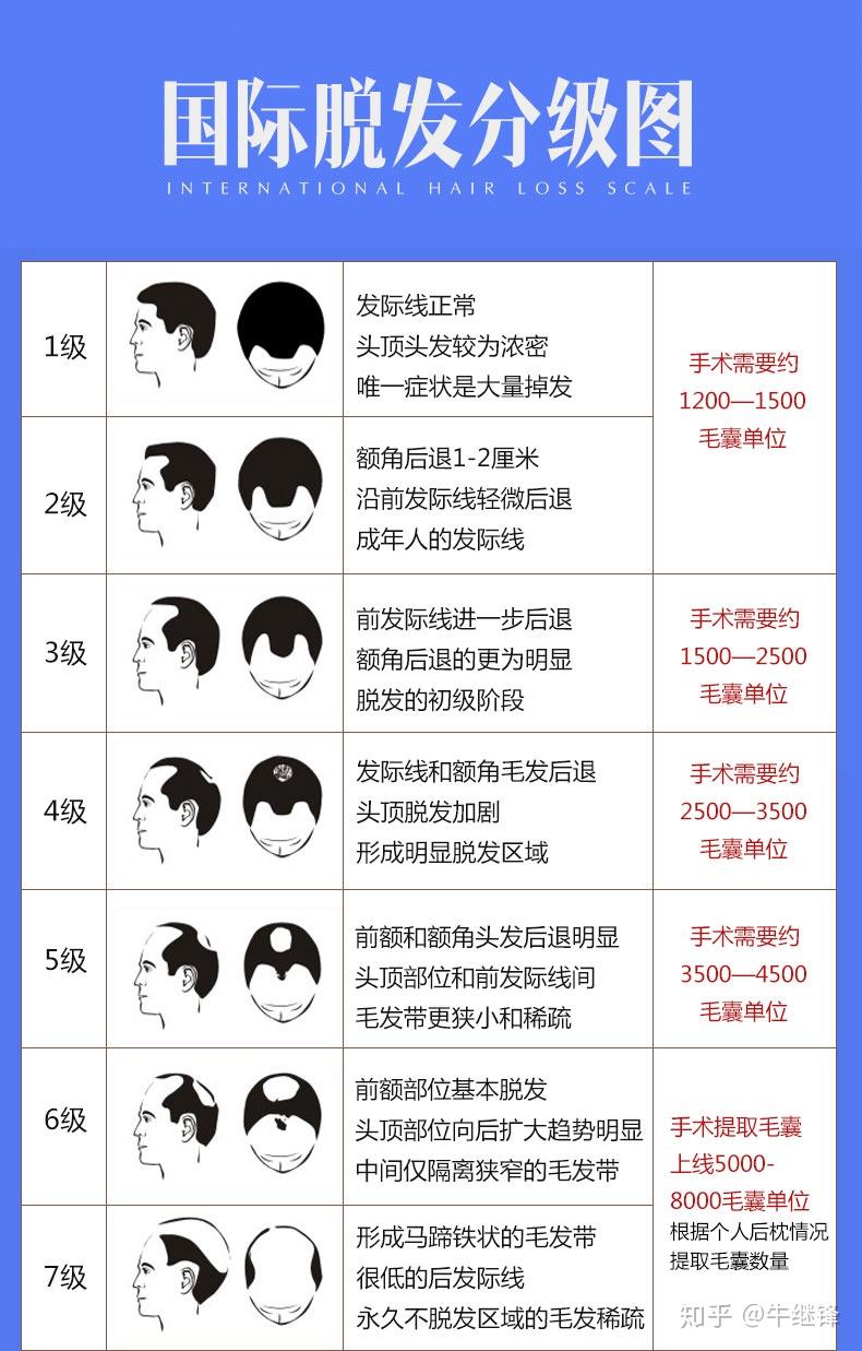 健康的毛囊移植到需要改善的区域来改善发际线较高也就是额头高的情况