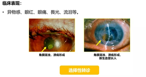 常见眼部症状和处理——异物感 - 知乎